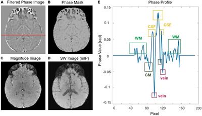 Susceptibility-weighted imaging at high-performance 0.5T magnetic resonance imaging system: Protocol considerations and experimental results